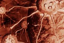 SVJETSKI DAN BORBE PROTIV RAKA